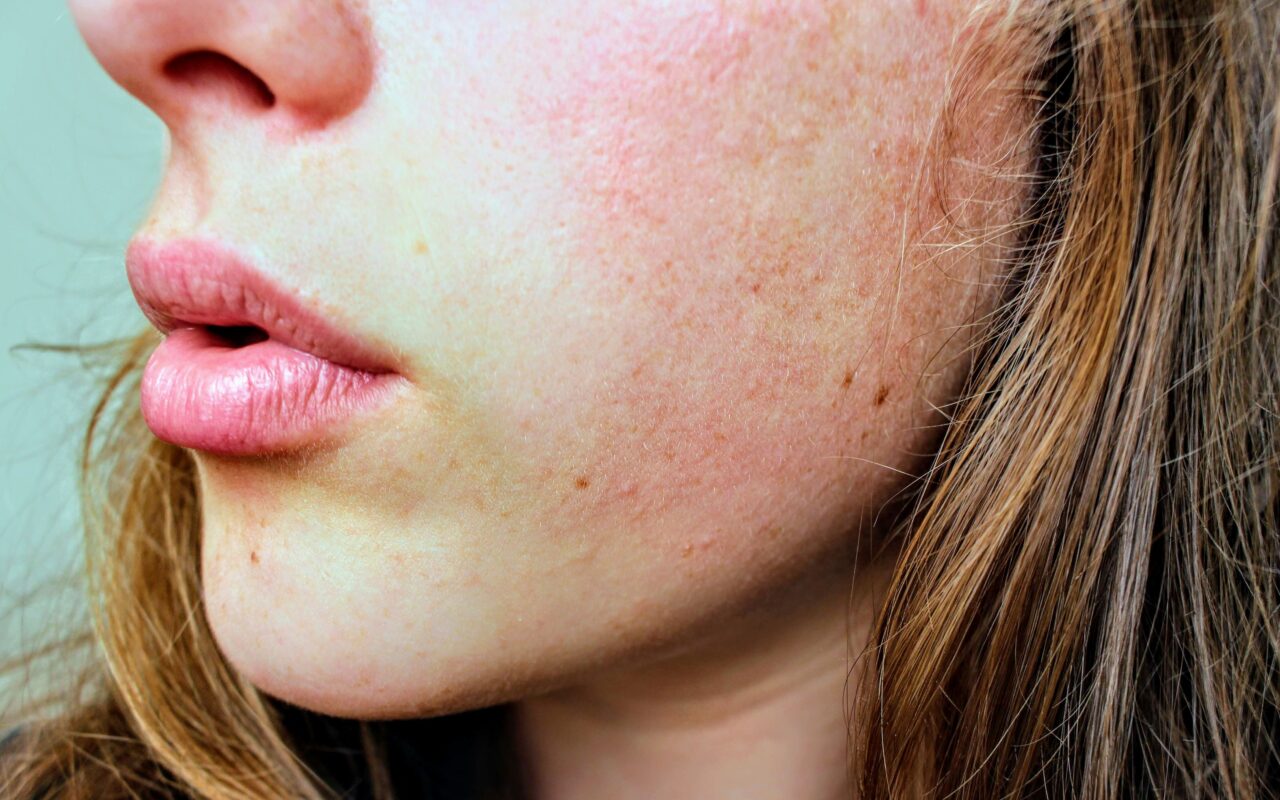 skin infection